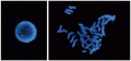 A FISH image showing a deletion at chromosome 22q11.2