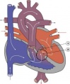 Double Outlet Right Ventricle.jpg