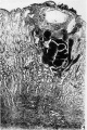 Fig 4 Blastocyst directly beneath surface hemorrhage