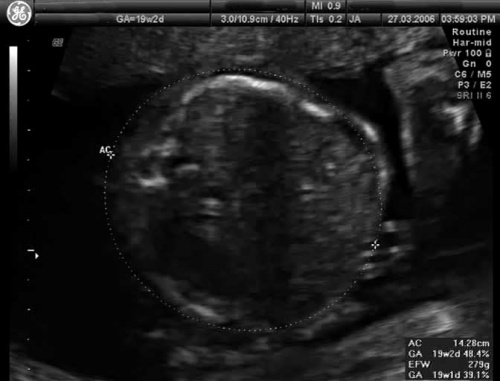 Ultrasound Fetal (GA 19 weeks) Ultrasound scan through the fetal trunk to measure abdominal circumference (AC).