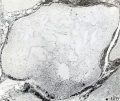 Fig. 128. Section of a villus from No. 749, showing accumulation of Hofbauer cells, especially at the right. X50.