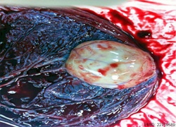 Placental chorioangioma 03.jpg