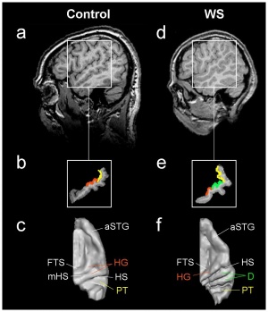 Auditory Cortex Location - Comparison Between Control Subject and WS Subject.jpg