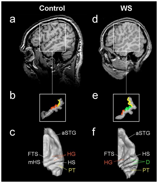 File:Auditory Cortex Location - Comparison Between Control Subject and WS Subject.jpg