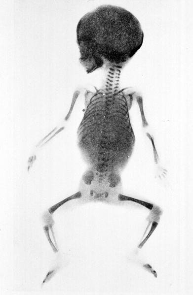 File:Fetal 5 month x-ray.jpg