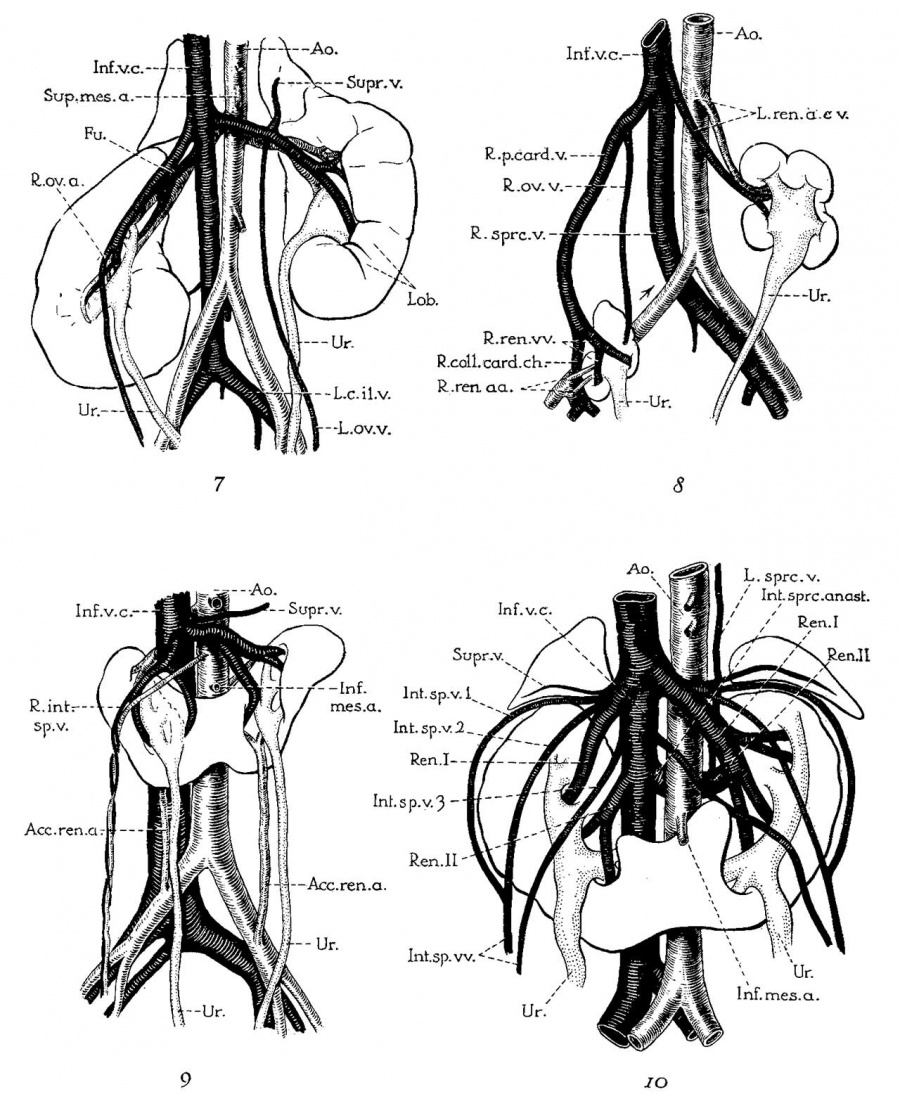 Paper Description of a horseshoe kidney Embryology