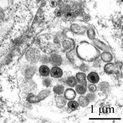Cytomegalovirus infected spermatozoa EM01.jpg