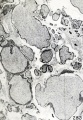 Fig. 283. Cross section of intensely fibrous villi from No. 7656. (See Chapter XV.)