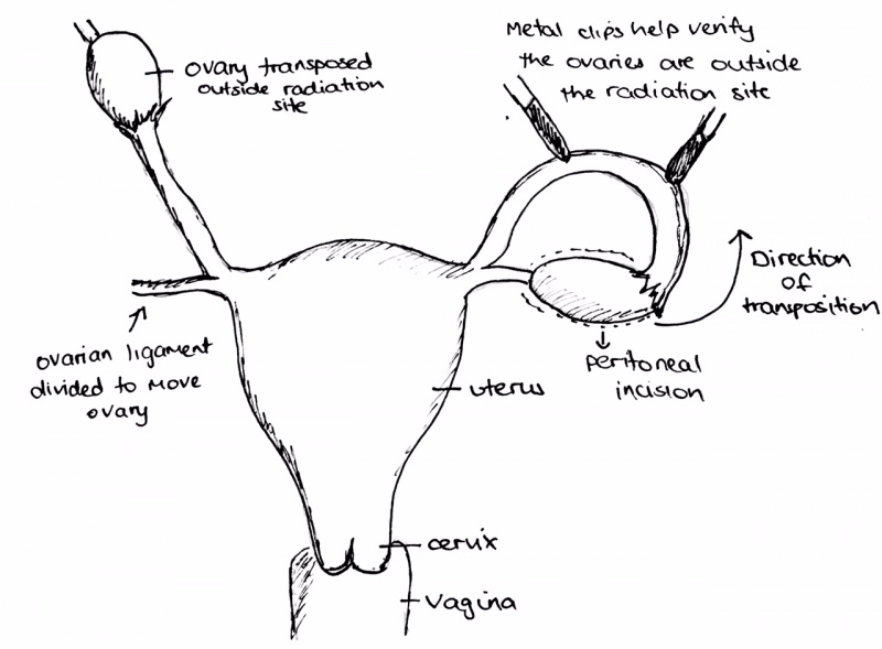 File:Ovarian transposition.jpeg