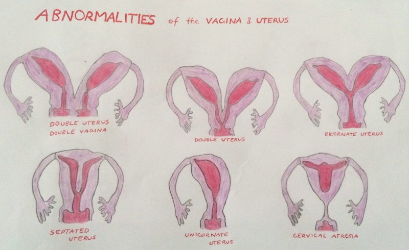File:Uterus and Vagina Abnormalities.jpg