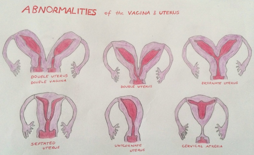 Uterus and Vagina Abnormalities.jpg