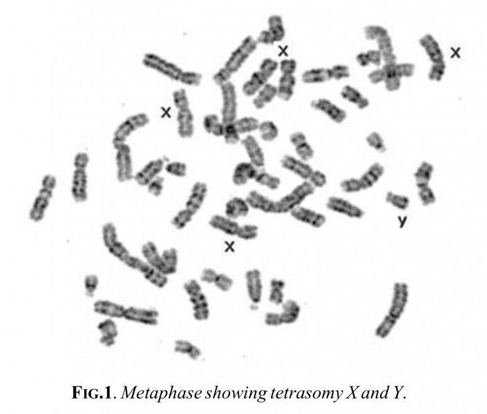 File:Male tetrasomy X karyotype.jpg