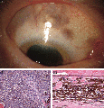 Fig 18 Ciliochoroidal melanoma in eye Z5165679
