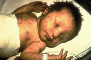 Infant rubella virus