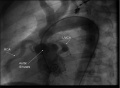 Figure 9: Left Ventricular Cine angiography picture demonstrating Supravalvular aortic stenosis in a 12 year old Williams Syndrome patient