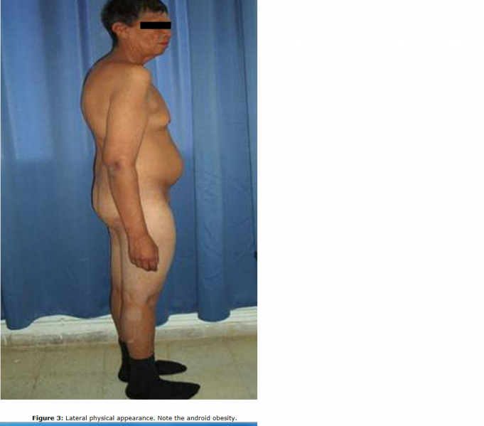 File:Male with 48,XXYY Syndrome.png