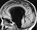 Magnetic Resonance image showing Arachnoid Cyst with Hydrocephalus