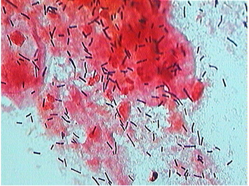 File:Bacteria - gram-stained vaginal smear 06.jpg
