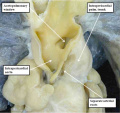 fig 41a Human aortopulmonary window