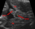 Ultrasound of male fetus