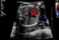 Ultrasound Ventricular septal defect