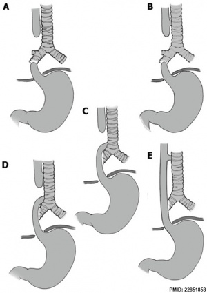 Classification of Oesophageal atresia.jpg