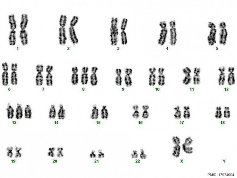 File:Trisomy 8 and trisomy 13 karyotype.jpg