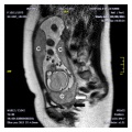Multilobed placenta MRI
