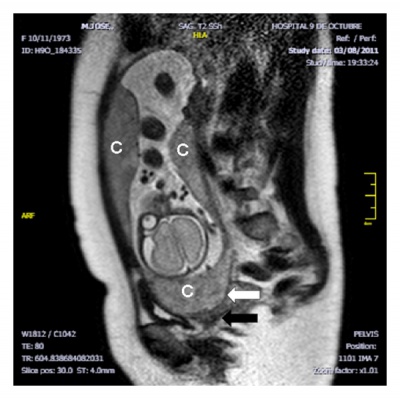 Multilobed placenta MRI01.jpg