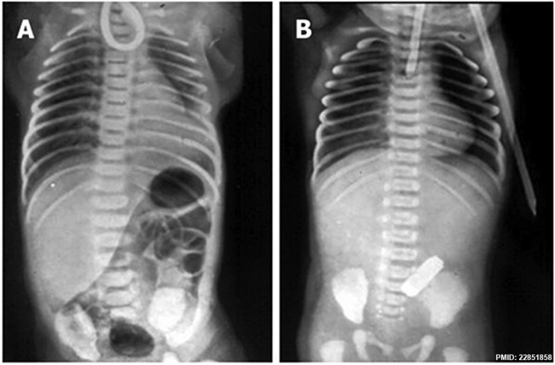 File:Oesophageal atresia x-ray 01.jpg