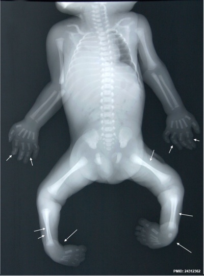 Human fetus skeleton x-ray 02.jpg