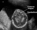 Fig 14 nferior image of a fetal cerebellum at second trimester