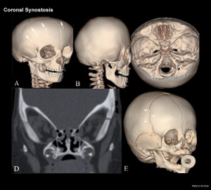 Skull CT abnormal 02.jpg