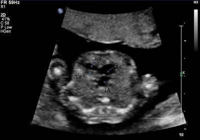 Ultrasound - Hypoplastic left heart syndrome 02.jpg