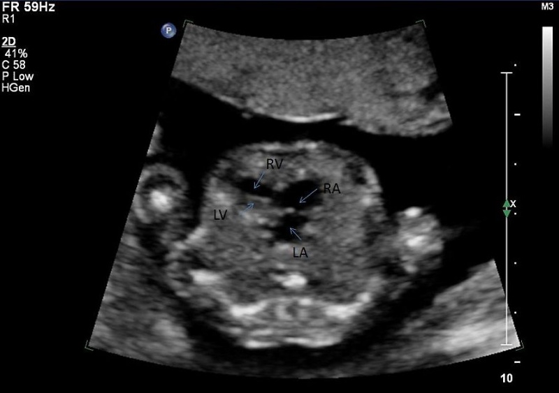 File:Ultrasound - Hypoplastic left heart syndrome 02.jpg
