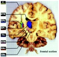 Regions of the brain significant in Huntington's disease in the HTT gene can cause cellular and clinical complications.