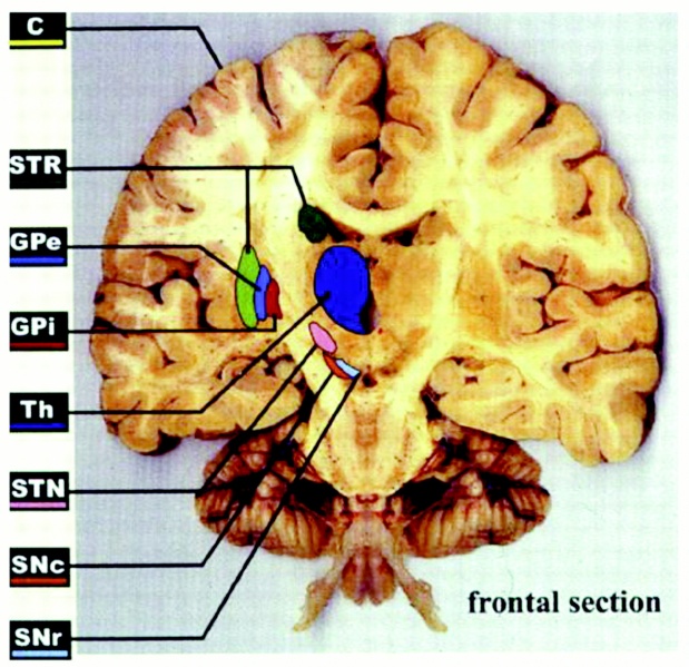 File:Regions of the brain significant in Huntington's disease.jpg