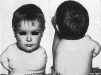 Thalidomide affected Infant