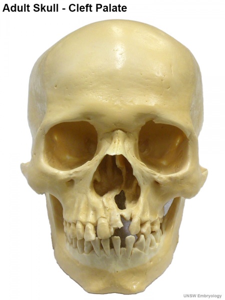 File:Adult skull cleft palate 01.jpg