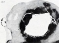 Fig. 167. Section of part of the same specimen, showing the clot which contains the empty vesicle largely surrounded by ovarian stroma. XI. 9.