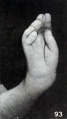 Fig. 93. Right hand with six fingers from macerated specimen. No. 1749. There were six digits on each of the four extremities. X3.