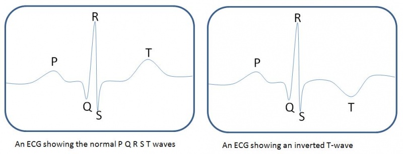 File:Schematic ECG normal and inverted T-wave.jpg