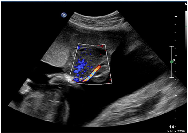 File:Placental chorioangioma ultrasound 02.jpg