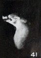 Fig. 41. Cyema classed as fetuses compressus. No. 1245. X3.