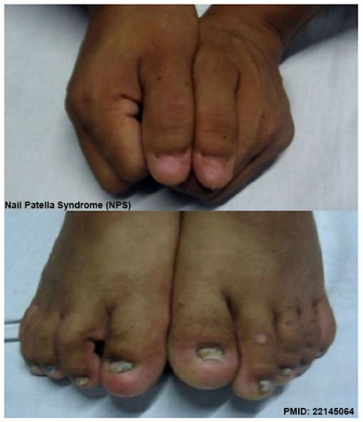 File:Nail patella syndrome 01.jpg