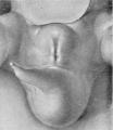 Fig. 2. Carnegie Embryo No. 792, 8 mm