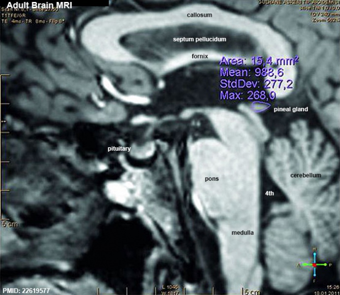 File:Adult human brain MRI01.jpg