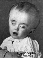 Hydrocephalus