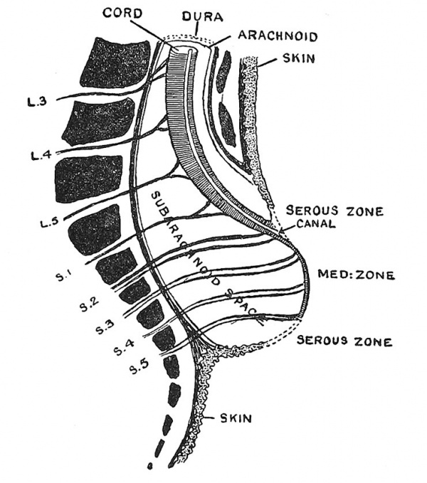 Fig. 79 Vertical Section of the Lumbar Region to show the arrangement of parts in a typical case of cystic spina bifida.