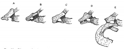 Fig. 50 Diagram showing the variation in the development of the costal element of the seventh Cervical Vertebra in 72 skeletons.